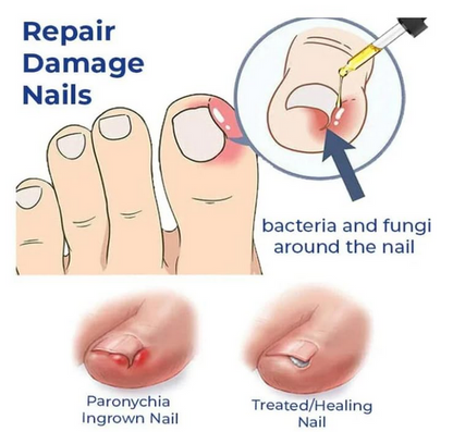Anti Paronychia Relief Oil- Buy 1 Get 1 Free